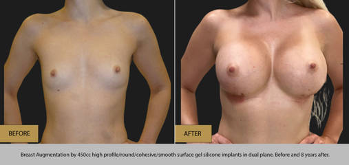Breast augmentation by 450cc gel silicone implants in dual plane before and after 8 years