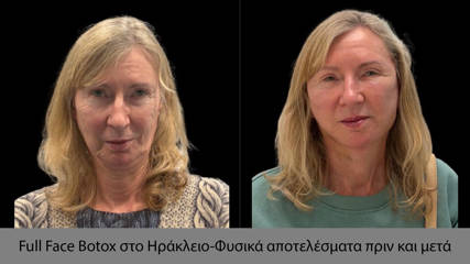Full Face Botox in Heraklion – Natural results before and after