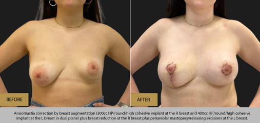 Before and after correction of breast asymmetry with 300cc and 400cc high profile silicone implants, reduction, and lift