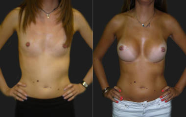 Before and after of breast augmentation showing improved fullness and lifted appearance with silicone implants