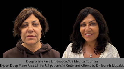 Deep Plane Lifting Προσώπου στην Ελλάδα / Ιατρικός Τουρισμός από τις ΗΠΑ. Εξειδικευμένο Deep Plane Lifting Προσώπου για ασθενείς από τις ΗΠΑ στην Κρήτη και την Αθήνα από τον Δρ. Ιωάννη Λιαπάκη.