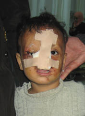 Young child recovering after reconstructive facial surgery