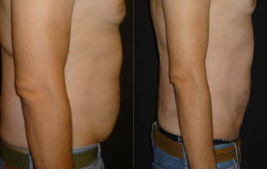 Before and after comparison of a man's torso showing abdominal fat and a flatter stomach following liposuction