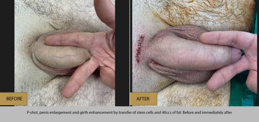 Before and after P-Shot penis enlargement and girth enhancement using 40cc fat and stem cell transfer
