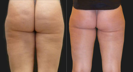 Before and after liposuction on thighs and buttocks showing smoother skin and improved contour 
