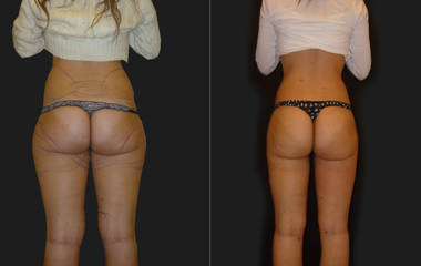 Before and after liposuction showing enhanced waistline and improved buttock contour
