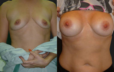 Before and after breast augmentation showing enhanced volume, lifted appearance and improved cleavage
