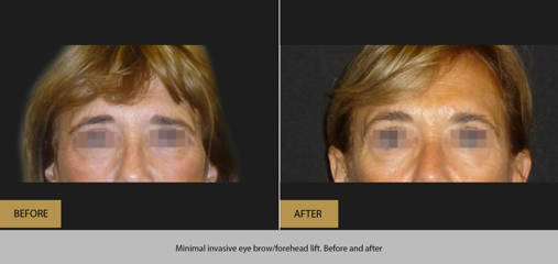 Before and after surgical eyebrow lift showing raised brows and smoother upper-face contour