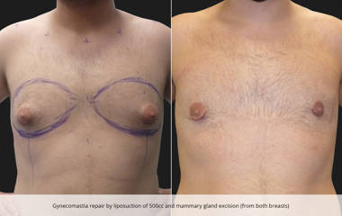 Before and after gynecomastia repair with 500cc liposuction and gland excision achieving a flatter chest