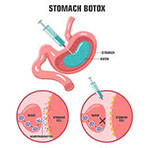 Γαστρικό Botox για μείωση βάρους