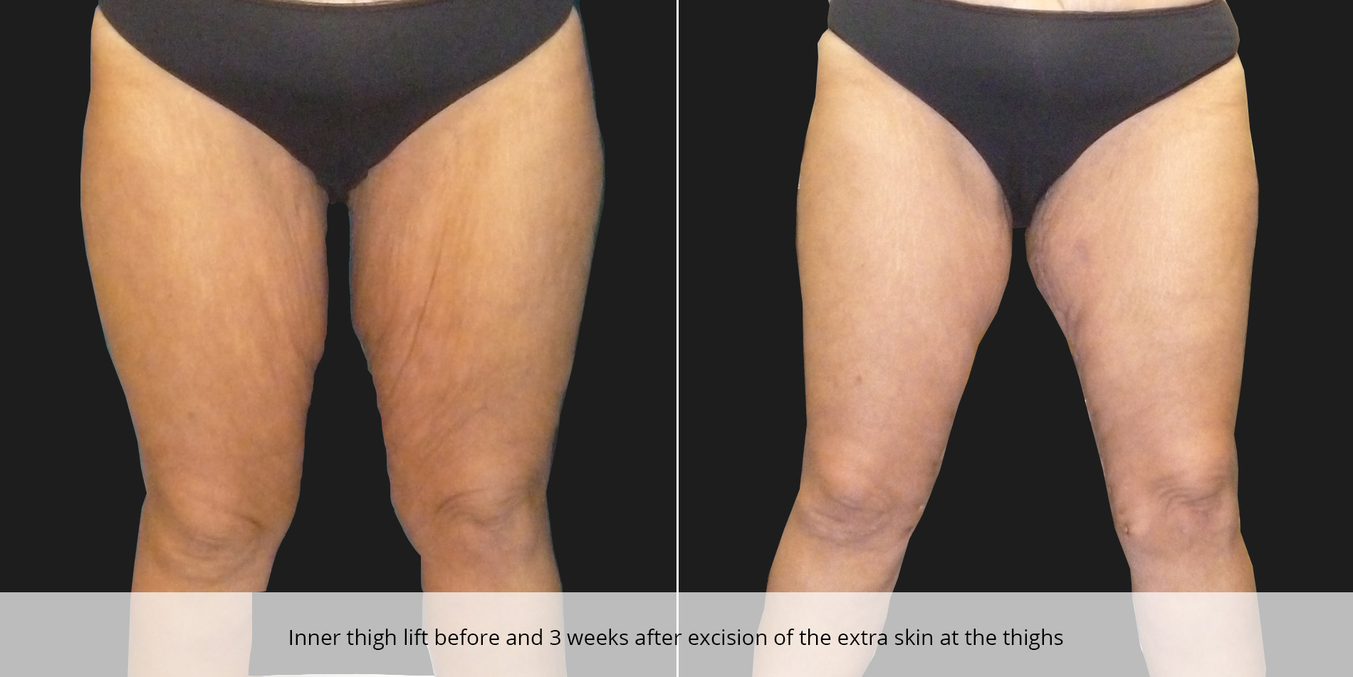 Body Cosmetic Procedures: inner thigh lift procedure, inner thigh lift  plastic surgery