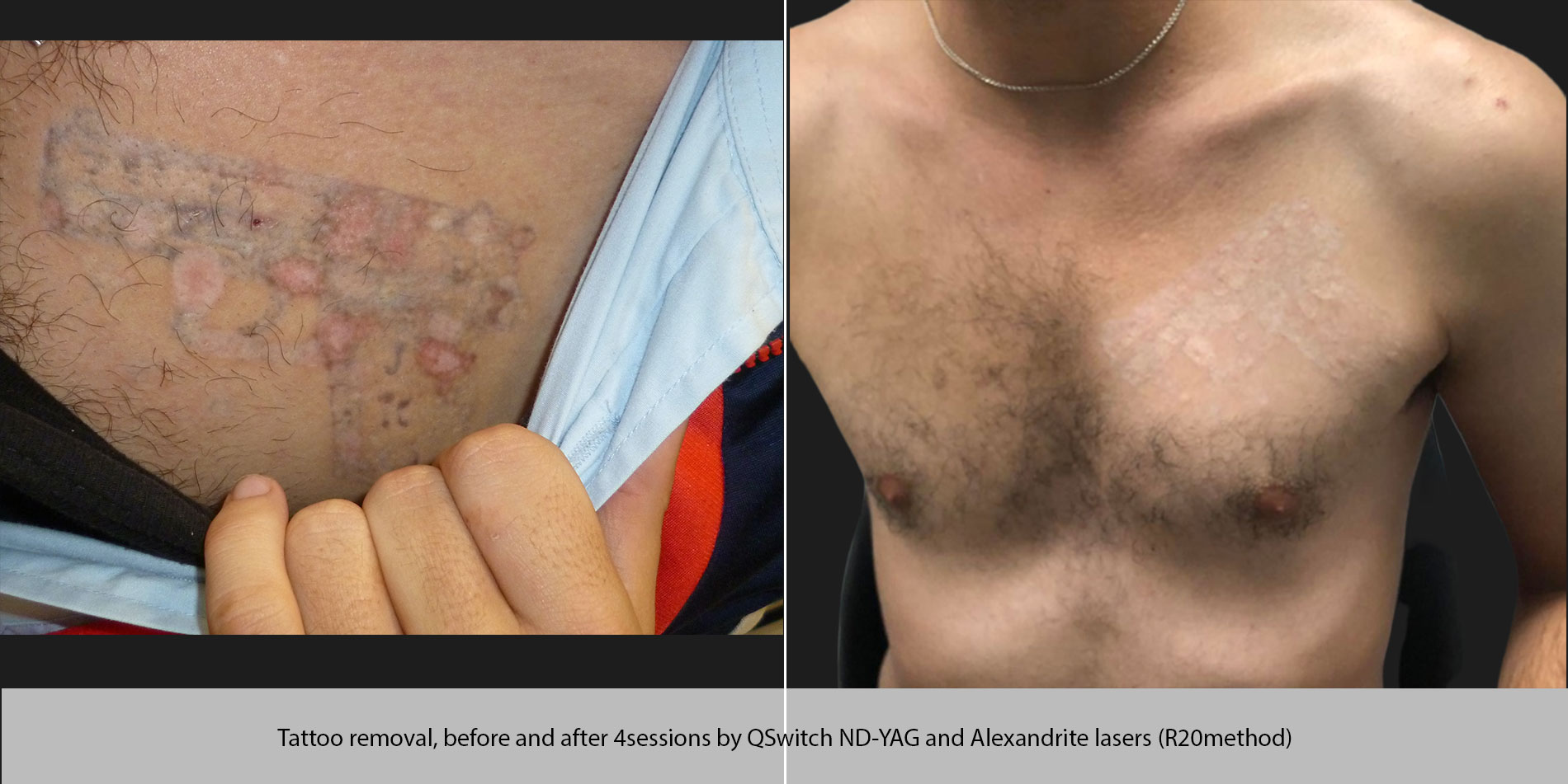 Skin Cosmetic Procedures: laser tattoo removal procedure greece