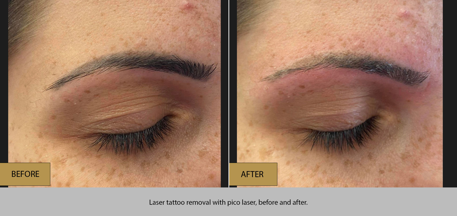 Tattoo Removal APK for Android Download #51 Tattoo Removal APK for Android Download