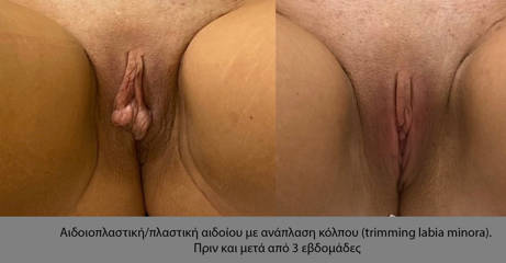 Labiaplasty 10
