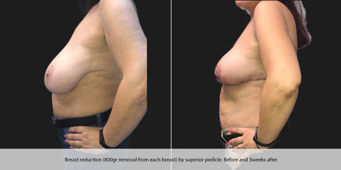 Before and after breast reduction showing lifted and lighter breast profile after 800gr tissue removal