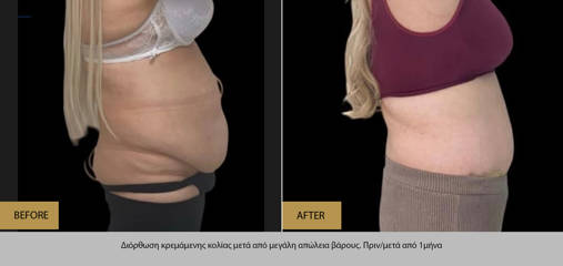 Correction of sagging abdomen after major weight loss, one month post high-definition abdominoplasty