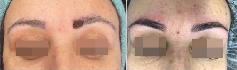 Before and after eyebrow micropigmentation showing refined brows with natural pigment shading