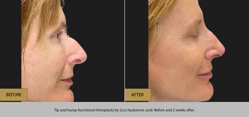 Side view of a woman before and after tip and hump functional rhinoplasty using 2ccs hyaluronic acid