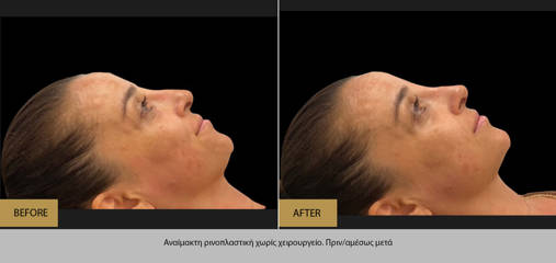 Before and after non-surgical rhinoplasty treatment