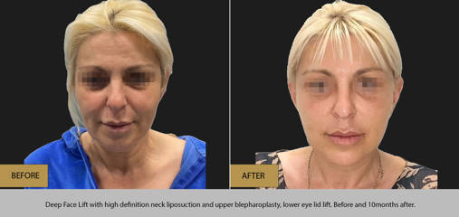 Before and 10 months after deep face lift with high-definition neck liposuction, upper blepharoplasty and lower eyelid lift