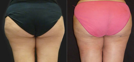 Before and after comparison of lower body showing reduced fat and smoother skin texture following liposuction treatment