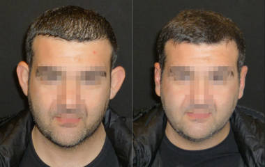 Before and after otoplasty showing correction of prominent ears for natural and symmetrical appearance