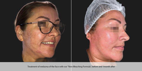 Before and one month after treatment of melasma of the face with our New Bleaching Formula