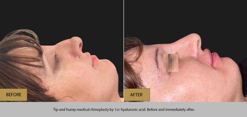 Side profile of patient before and after non-surgical rhinoplasty using 1cc hyaluronic acid