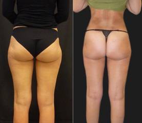 Before and after liposuction showing lifted buttocks, smoother thighs, and enhanced lower body contour