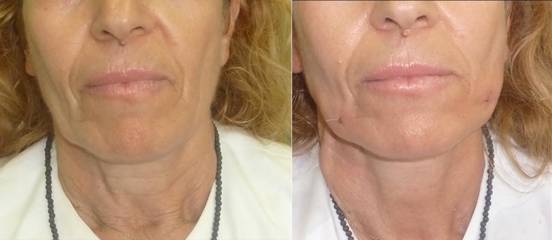 Before and after mesotherapy lipolysis on neck area showing reduced fat deposit and improved definition