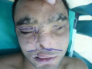 Patient with severe facial scarring before reconstructive surgery