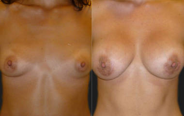 Breast augmentation before and after showing fuller breast volume and improved contour