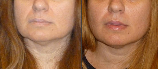 Before and after facial implant surgery showing fuller malar region and enhanced lower face definition
