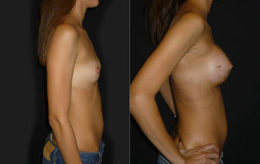 Side view before and after breast augmentation with silicone implants showing natural projection and contour
