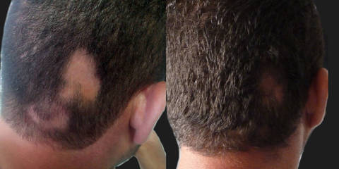 Before and after male hair transplantation showing restored hair density on previously thinning occipital scalp region