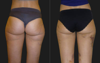 Before and after thigh and buttock liposuction showing refined contour and reduced fat