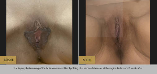Labiaplasty by trimming of the labia minora and 20cc lipofilling plus stem cells transfer at the vagina
