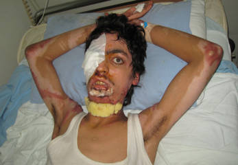 Patient recovering from severe explosion trauma and burns