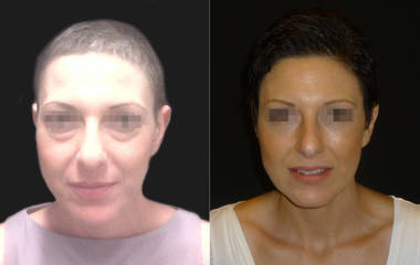 Before and after lower blepharoplasty showing reduced under-eye puffiness and a smoother facial appearance