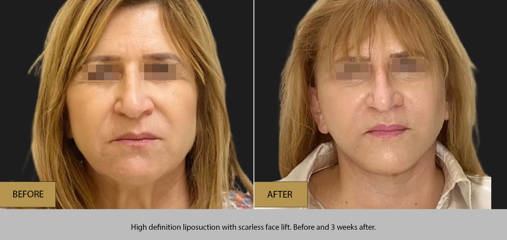 Before and 3 weeks after high definition liposuction with scarless face lift