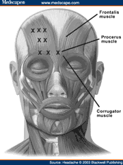 Illustrated diagram showing typical injection points for botulinum toxin treatment on facial muscles