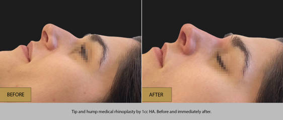 Before and after side profile of non-surgical rhinoplasty using 1 cc hyaluronic acid to smooth nasal hump and refine tip