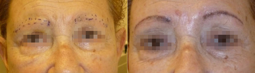 Before and after eyebrow micropigmentation showing fresh pigment and well-defined brows