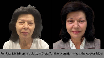 Full Face Lift & Blepharoplasty in Crete: Total rejuvenation meets the Aegean blue! 