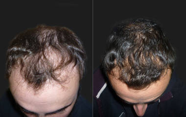 Before and after hair transplantation showing increased scalp hair density and restored bald area coverage