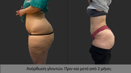 Liposuction65