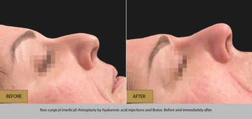 Before and after non-surgical rhinoplasty using hyaluronic acid and Botox