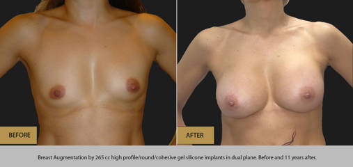 Before and after breast augmentation with 265cc silicone implants, showing long term natural enhancement results