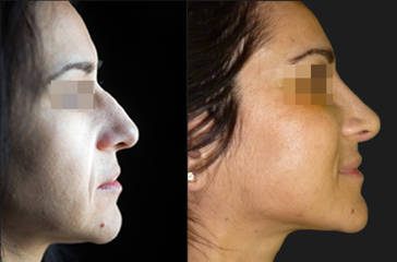Before and after  side view rhinoplasty with reduction of nasal hump and refined tip