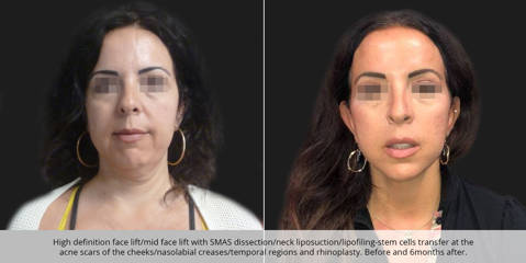 Before and six months after high definition face lift with SMAS dissection and neck liposuction